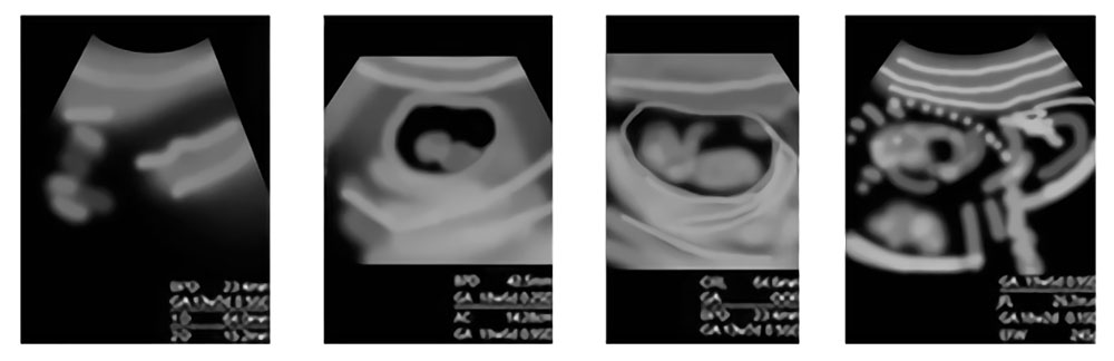 母体内の胎児のエコー写真